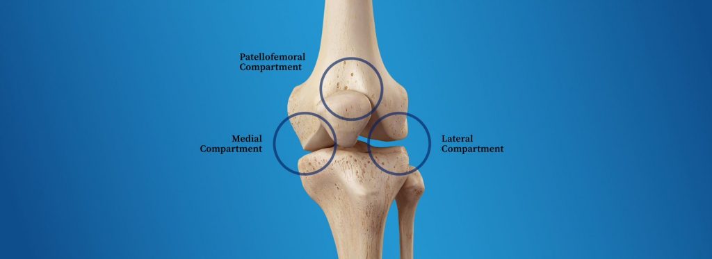 tricompartmental osteoarthritis diagram